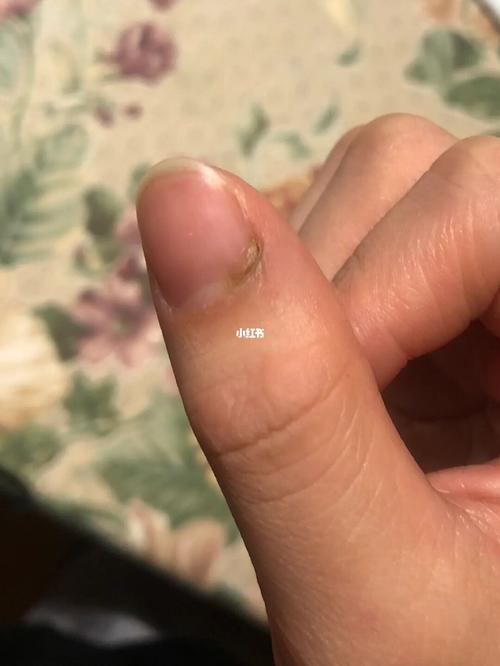 指甲根部发黑_医疗健康_医疗健康其他