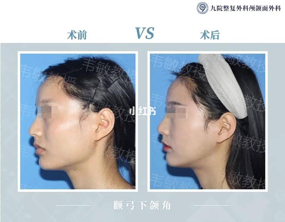 颧弓下颌角术让脸更小更年轻