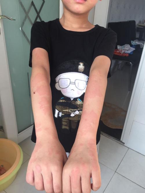 是这是油漆过敏的症状吗?