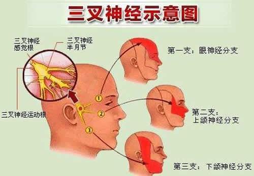 妈妈三叉神经痛,洗脸刷牙都不敢,怎么办?
