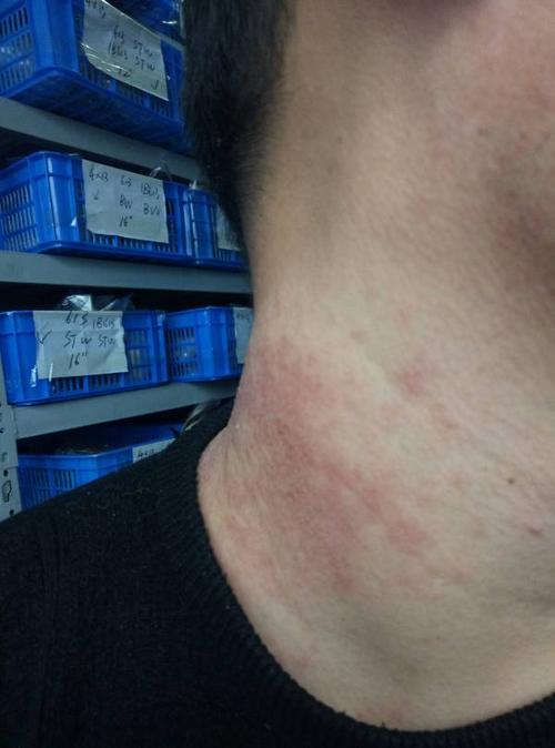 这个是湿疹,还是什么