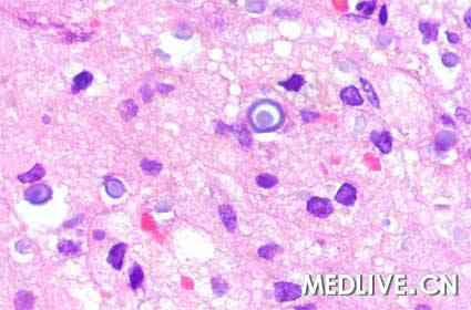 罕见病例:肾脏软化斑合并多囊肾病变1例