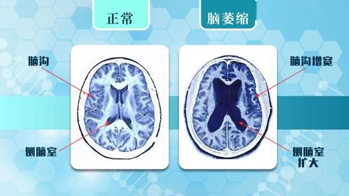 《脑萎缩》 就用这三招帮您搞定!