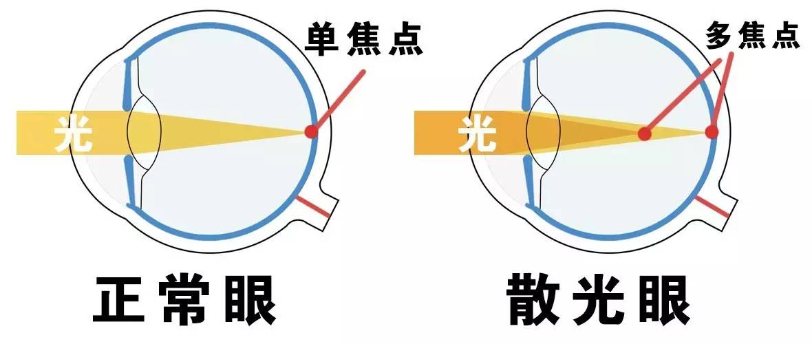 眼睛最大屈光度和最小屈光度之间的差值,即散光的度数;散光