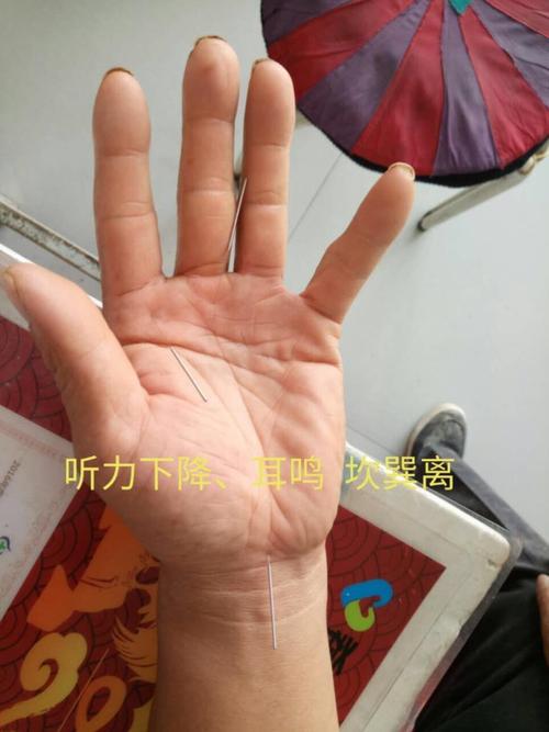 全息八卦手针病例相册