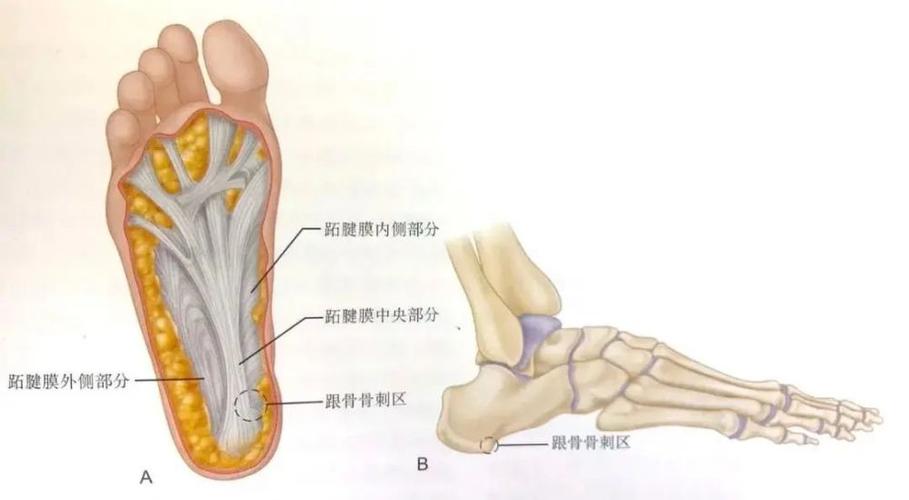 骨科精读|从解剖到治疗,一文读懂足底筋膜炎分期诊治