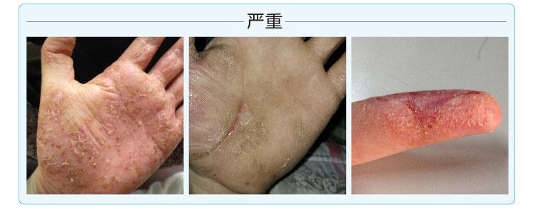 汗疱疹的主要症状