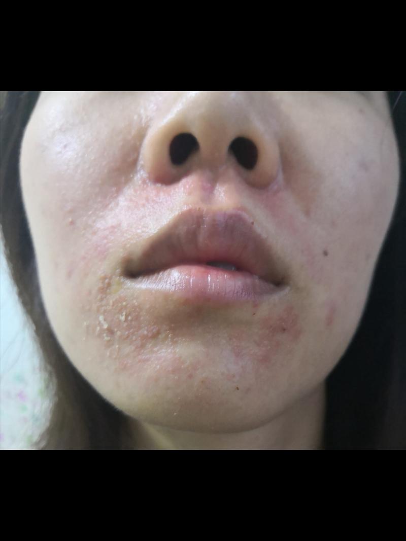 混油皮口周皮炎,脂溢性皮炎修复史_皮炎_屏障受损_混油皮_皮肤问题_去