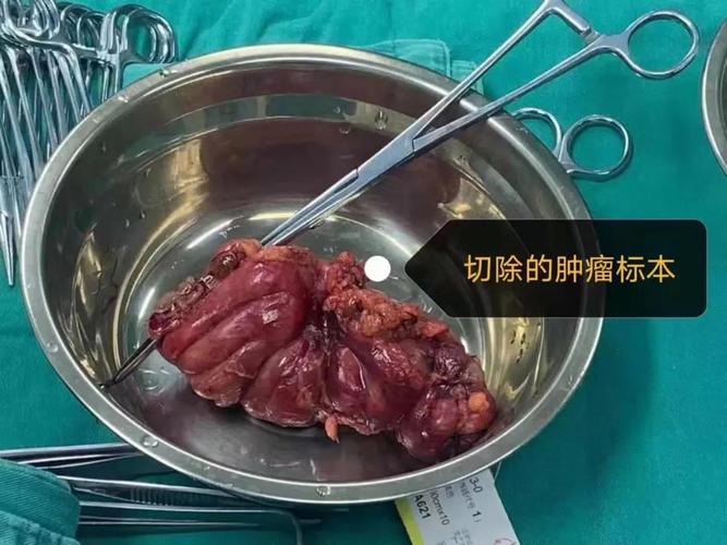 病案一线去年结肠癌手术改道今朝造瘘还纳成功52岁大叔肠子终于通了