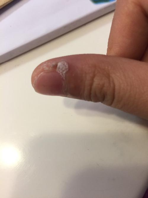 去年手上长了这个 查擦什么药都不好 有人说是鸡疣?有