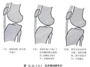 胫骨髁间嵴骨折切开复位术