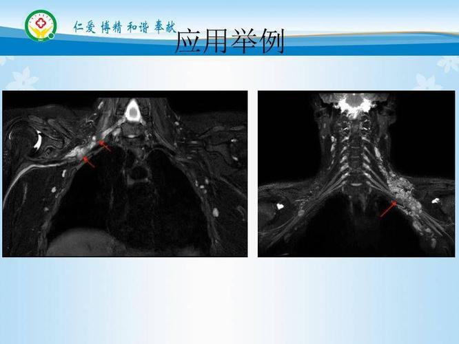 横轴位,清晰显示肿瘤与臂丛神经有明确界限.