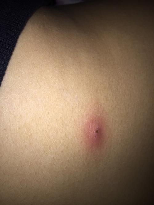 肚子上起了一个大点的痘痘,求解答