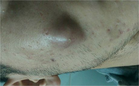 面部巨大的囊肿,能挤吗?