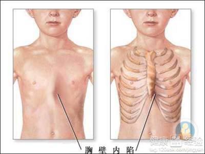 佝偻病发病率都大约在几岁发生