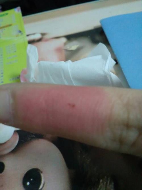 被仓鼠咬了一口怎么办?