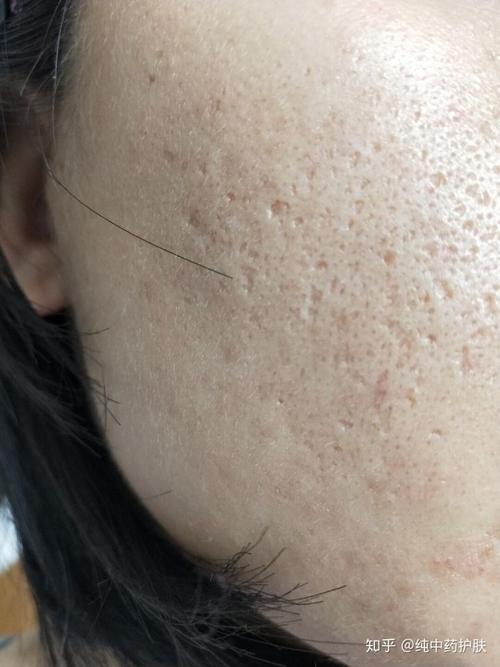 痘坑与痘印有什么区别