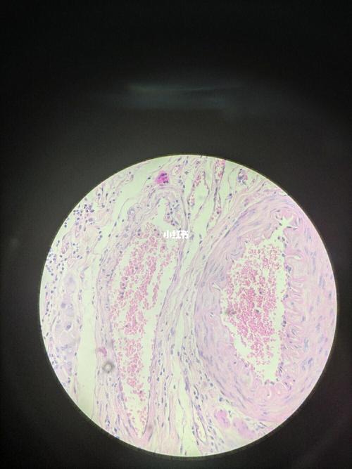 结肠腺癌切片_医疗健康_医疗健康其他