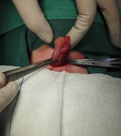 其临床表现是腹股沟或大阴唇内固定的囊性包块,和腹股沟斜疝的区别是