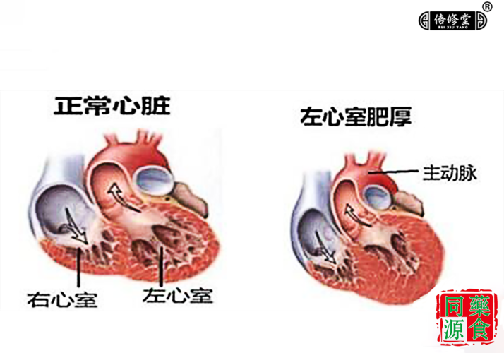 左心室因为代偿,逐渐变厚,扩张形成高血压性的心脏病,大多数发生在高