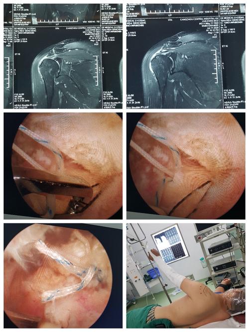 术中证实肩峰撞击综合征合并肩袖撕裂,关节镜下前建峰成型及肩袖缝合.