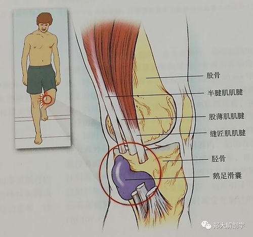 跪姿或下楼梯时加重07网球腿临床症状腓肠肌肌腱的急性损伤多见于网球
