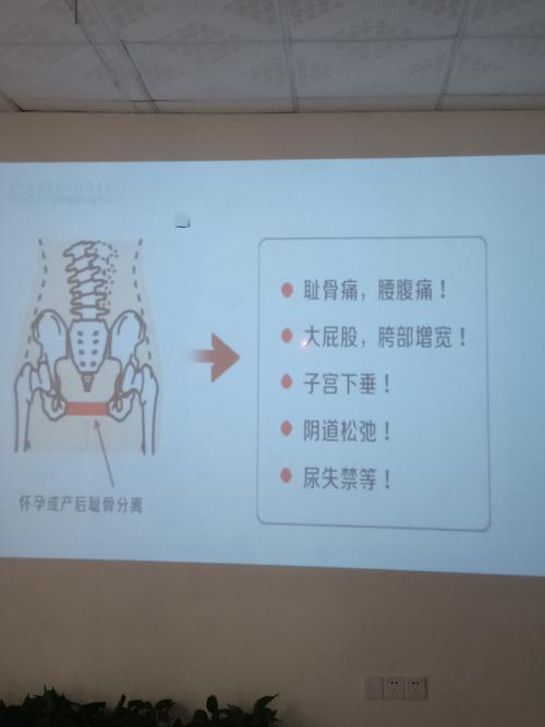 骨盆修复