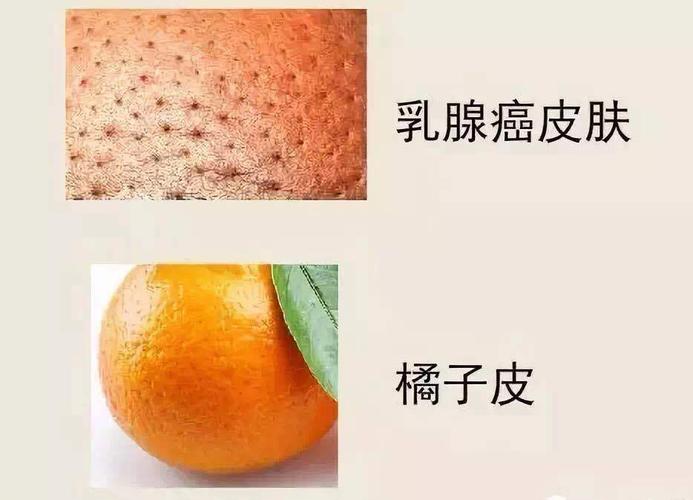 所以如果我摸的肿物很疼痛或像玻璃珠一样光溜溜的且能在乳房动来动去