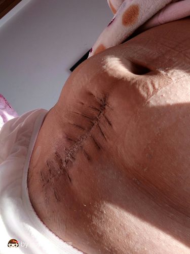 剖腹产这是恢复半个月时间的伤口自己看到都吓到了希望快点康复