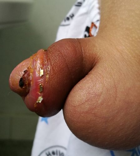 儿童包皮术后照片
