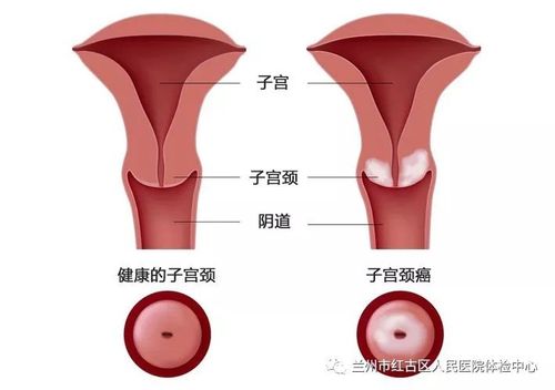 近40年由于宫颈细胞学筛查的普遍应用,使宫颈癌和癌前病变得以早期