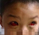 老师体罚将学生眼睛打出血