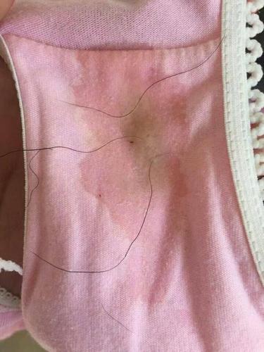 内裤上有褐色分泌物怎么回事 试管移植有褐色物分泌