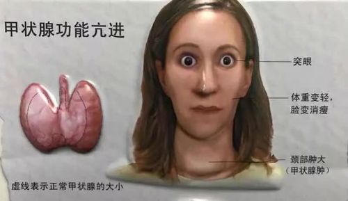 甲亢患者的眼睛从"含情脉脉"变得"炯炯有神"有什么特点?