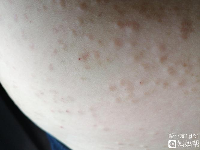 全身好痒,痒起来就冒出一粒一粒的疹子,有