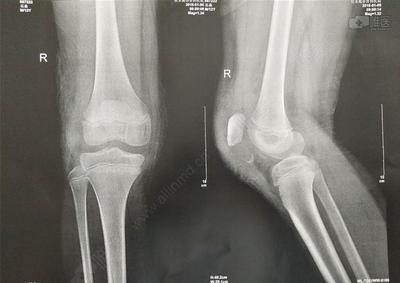 12岁儿童髌骨下极撕脱性骨折