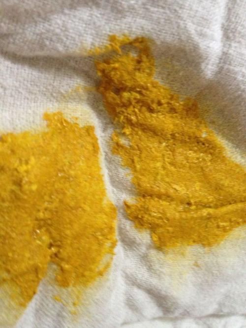 2,现在宝宝脸上黄疸还没有退掉,有时宝宝有白眼现象.