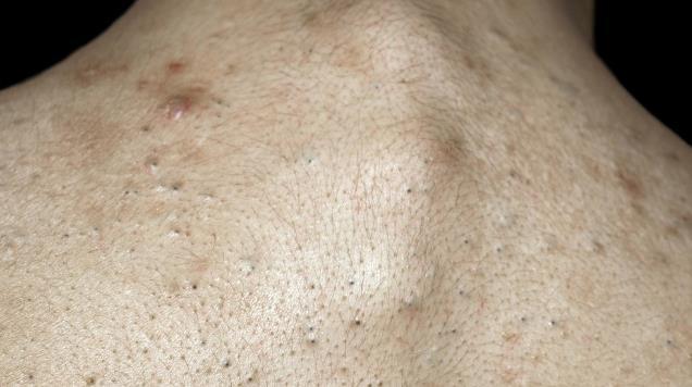 后背痘痘一片长,如果还有这3症状,说明后背螨虫大面积