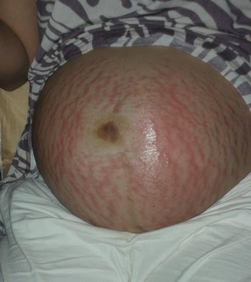 怎样区分"肥胖纹和妊娠纹"?不妨关注一下这3点,孕妈不