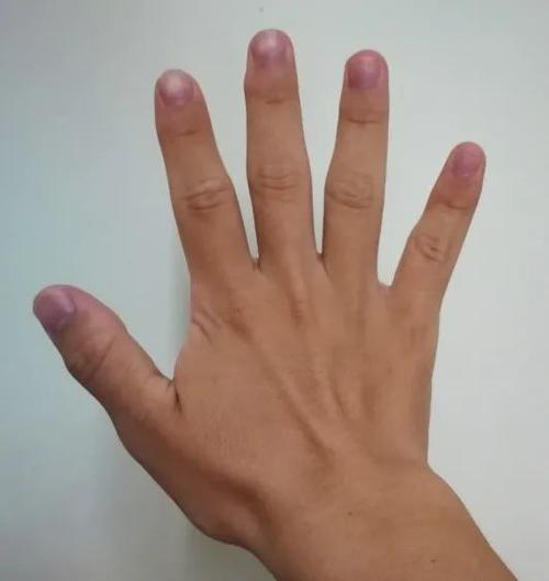 居然真的是肢端肥大丨作者供图 我心里一时说不清的滋味,一方面觉得