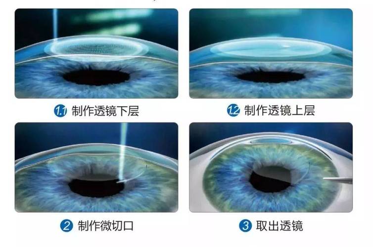 【科视眼科】近视手术真的越贵越好吗?