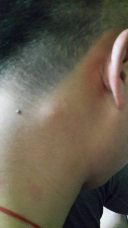 我脖子后面长了个包(见照片),几个月了