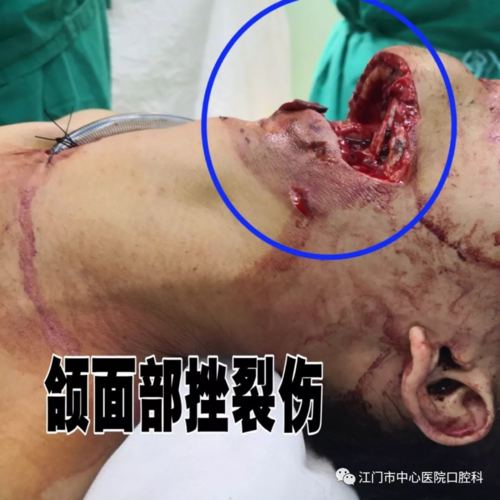 唾液腺炎症及肿瘤 口腔颌面部创伤 间隙感染张口受限(咬肌间隙)