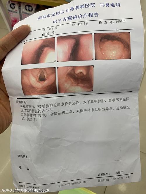 求助jr儿子腺样体手术的问题