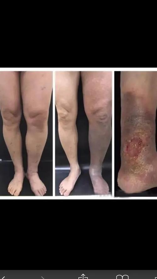 普外二科之 ——下肢静脉血栓的危害