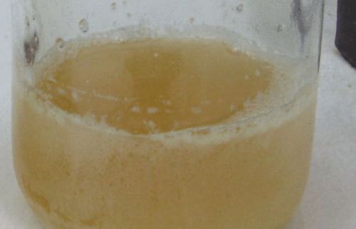 尿蛋白多见于肾脏疾病患者前期症状较为显著早发现早就医