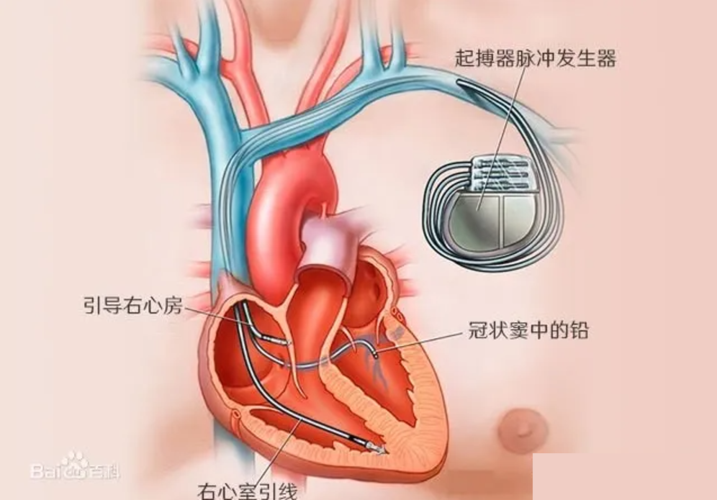 深度| 心脏起搏器那些事儿