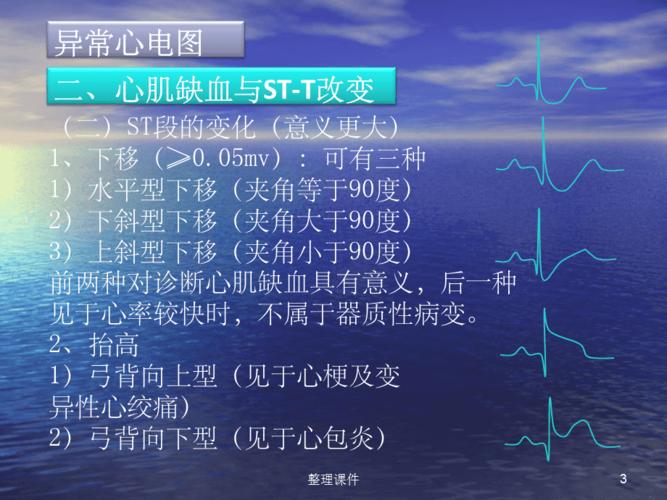 临床常见心电图判读