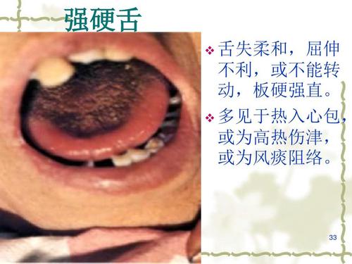 强硬舌   舌失柔和,屈伸 不利,或不能转 动,板硬强直.