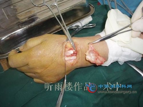 腱鞘囊肿手术全过程 请教